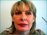 After sculptra treatment